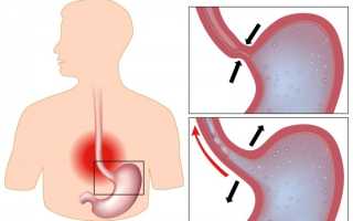 Чем опасен неэрозивный рефлюкс эзофагит? Симптомы и лечение