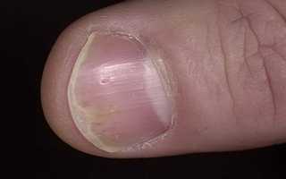 Терапия псориаза ногтей