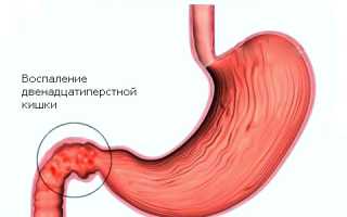 Как лечить бульбит желудка, его причины и симптомы