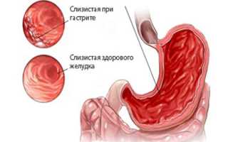 Признаки гастрита желудка: первые симптомы, сигнализирующие о заболевании