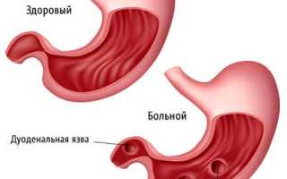 Лечение прополисом желудочно-кишечного тракта