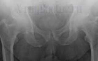 Рентгеновский снимок при коксартрозе