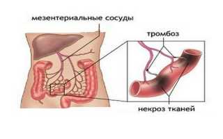 Лечение тромбоза кишечника, его причины и симптомы появления