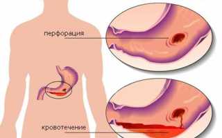 Желудочное кровотечение: причины и механизм развития, чем опасно, диагностика