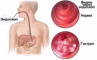 Гиперемирована слизистая желудка: что это значит, причины, лечение