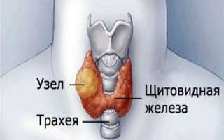 Узлы в щитовидной железе: симптомы, лечение и причины