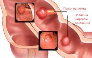 Лечение папиллом в кишечнике, причины их появления