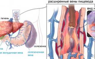 Причины варикозного расширения вен пищевода, их лечение