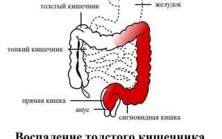 Симптомы и лечение воспаления кишечника