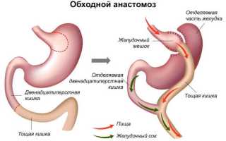 Что такое анастомоз кишечника, его виды, показания и проведение процедуры