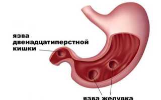 Питание при язве двенадцатиперстной кишки — рецепты