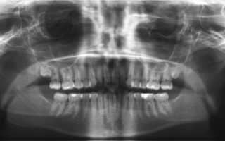 Современные способы проведения рентгенографии зубов, описание снимков