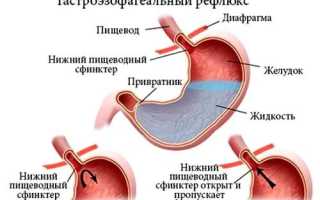 Лечение рефлюкса желудка, его симптомы и причины