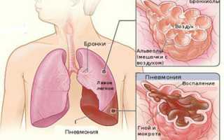 Лечение легкой степени пневмонии