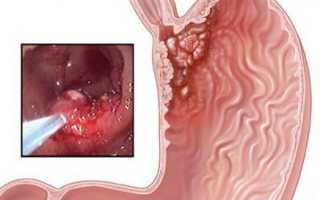 Причины и лечение аденокарциномы желудка, ее виды