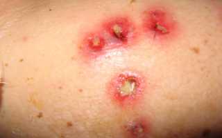 Виды эктимы, причины появления и лечение инфекции