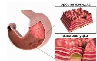 Причины возникновения эрозии желудка и ее лечение