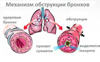 Причины и лечение обструктивного бронхита у детей