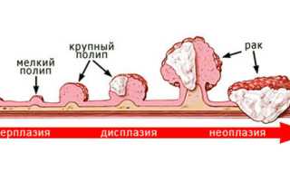 Удаление полипов в желудке, их причины и симптомы