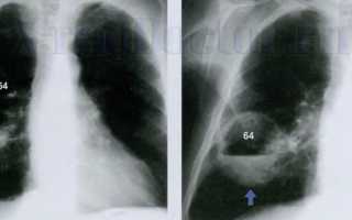 Рентген легких при пневмонии: как выглядят признаки воспаления на снимках
