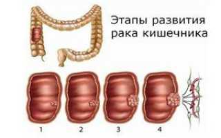 Спазмы в верхней части живота — причины и виды заболеваний