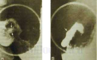 Прободная язва и рак желудка на рентгене