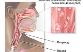 Кандидоз пищевода: когда появляется поражение слизистой грибком и как его устранить