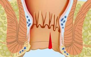 Консервативное лечение трещины прямой кишки