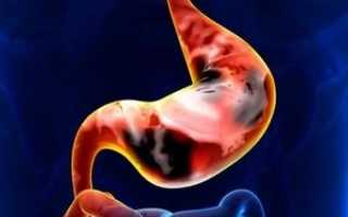 Рак пищевода: первые симптомы, сигнализирующие о начале развития опухоли