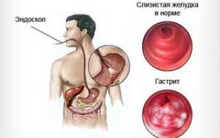 Антральный поверхностный гастрит: причины, симптомы и методы лечения