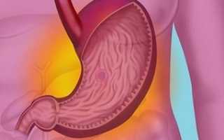 Острый гастрит: причины воспаления слизистой желудка и его диагностика