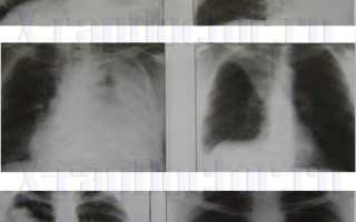 Рентген показал затемнение в легких или темное пятно – что это означает?