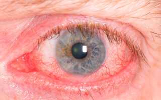 Ожог глаза после процедуры наращивания ресниц
