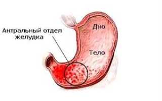 Хронический антральный гастрит: как распознать и лечить, диета