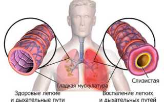 Причины, симптомы, лечение пневмонии и отека легкого