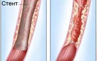 Стентирование пищевода: что это за процедура и для чего она необходима