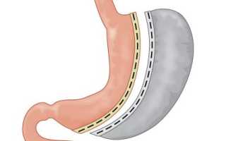 Операция по удалению желудка — кому и когда показана