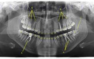 Рентген ОПГ — зачем делается, что показывает