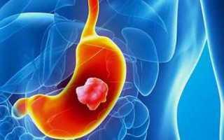 Рак желудка: прогноз выживаемости пациентов в зависимости от вида и стадии болезни