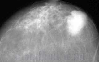 Рентген грудной клетки и груди — что показывает, как и зачем делается