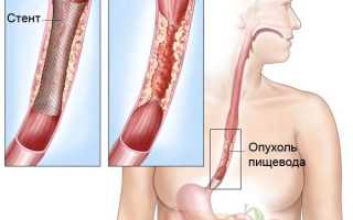 Рак пищевода: симптомы, свидетельствующие о наличии новообразования злокачественного течения
