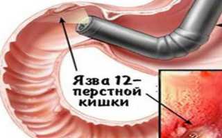 Лечение язвы двенадцатиперстной кишки, ее симптомы и диагностика