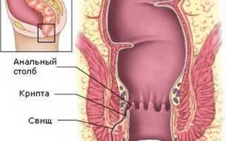 Причины появления свища в прямой кишке, его лечение