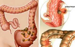 Способы лечения дивертикулеза кишечника, его причины и симптомы