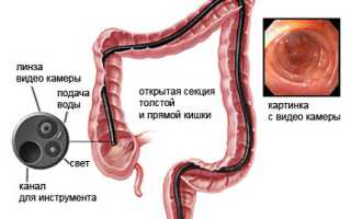 Как проводится колоноскопия кишечника, ее показания и противопоказания