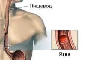 Симптомы язвы пищевода: по каким признакам можно распознать развитие болезни