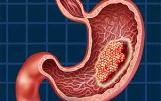 Лимфома желудка: виды, формы и стадии развития, как проявляется и лечится, прогноз