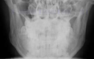 Рентген челюсти и челюстного сустава — что показывает, когда делают ребенку и взрослому
