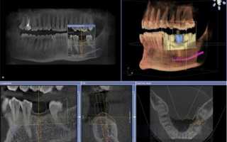 Трехмерный рентген зубов (3d) — показания, вредность, фото снимков