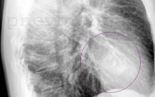 Рентген легких в двух проекциях для точной диагностики болезней